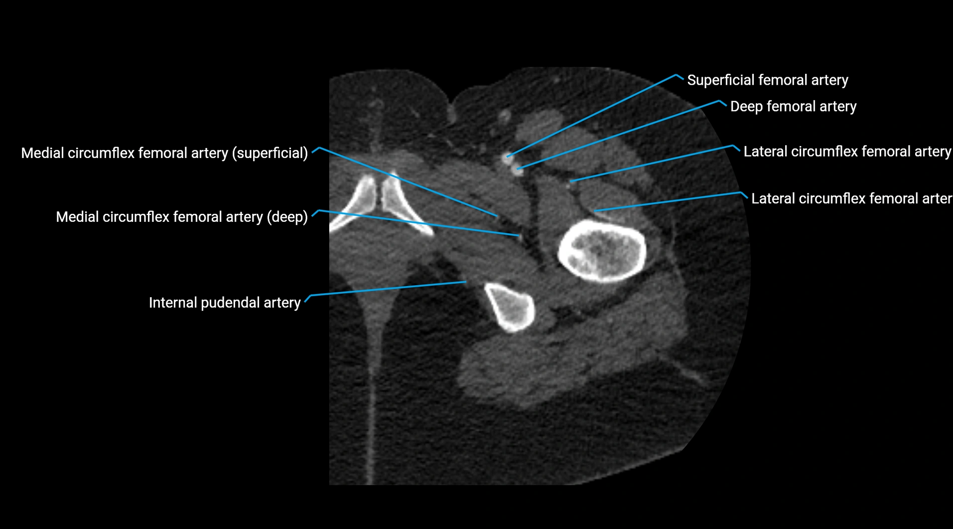 CTA lower limb cross sectional anatomy labelled image _70.webp